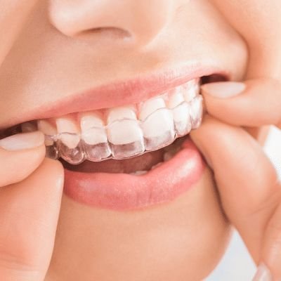  Aligners Treatment