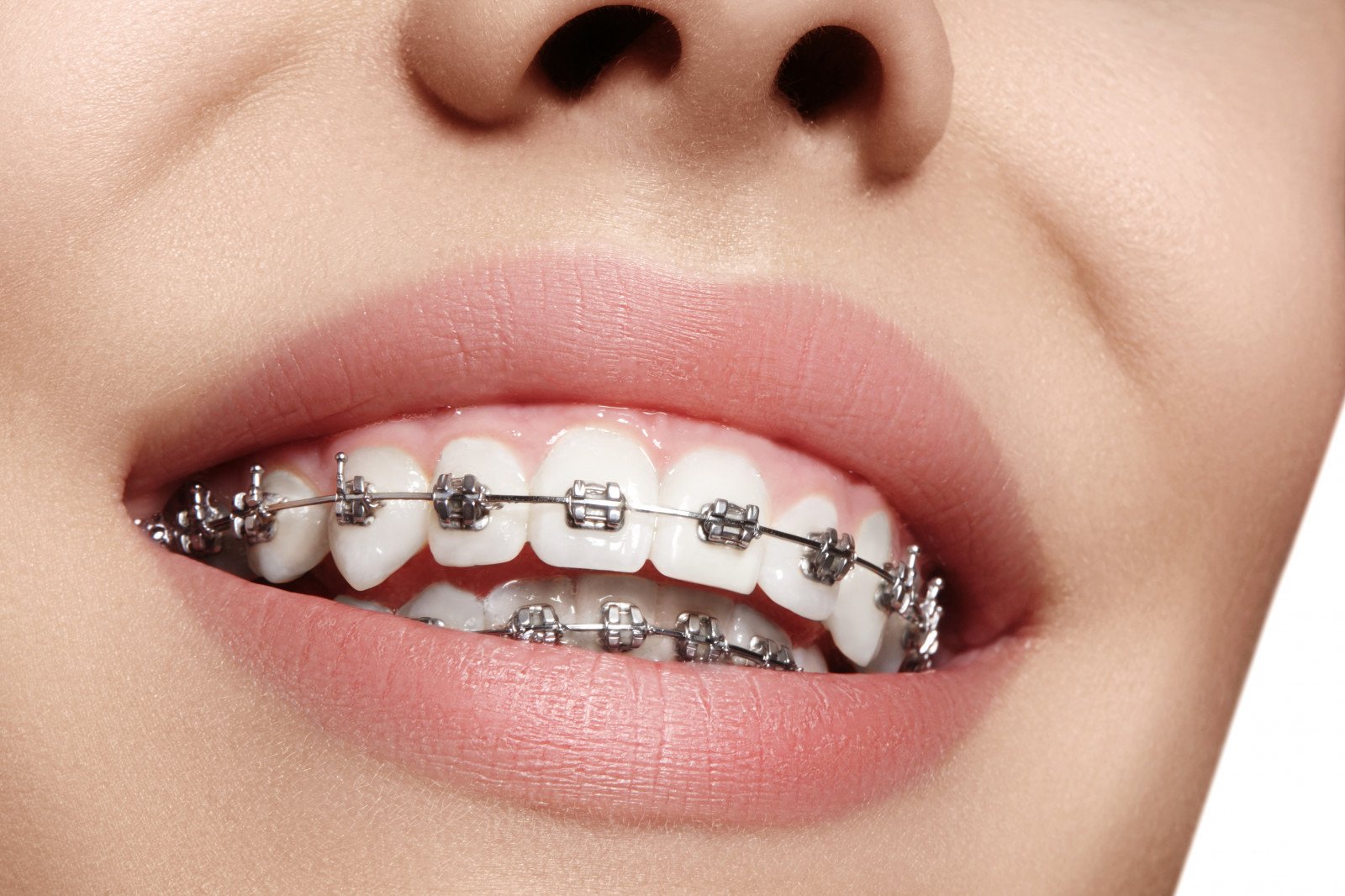 Braces and Orthodontics